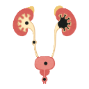 Kidney Stone Treatment