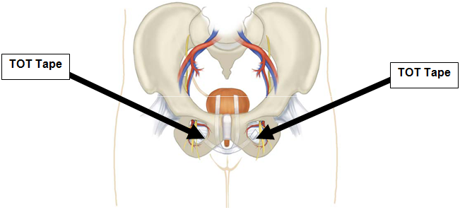 Transobturator Tape