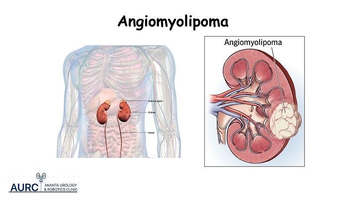Kidney anatomy showing angiomyolipoma