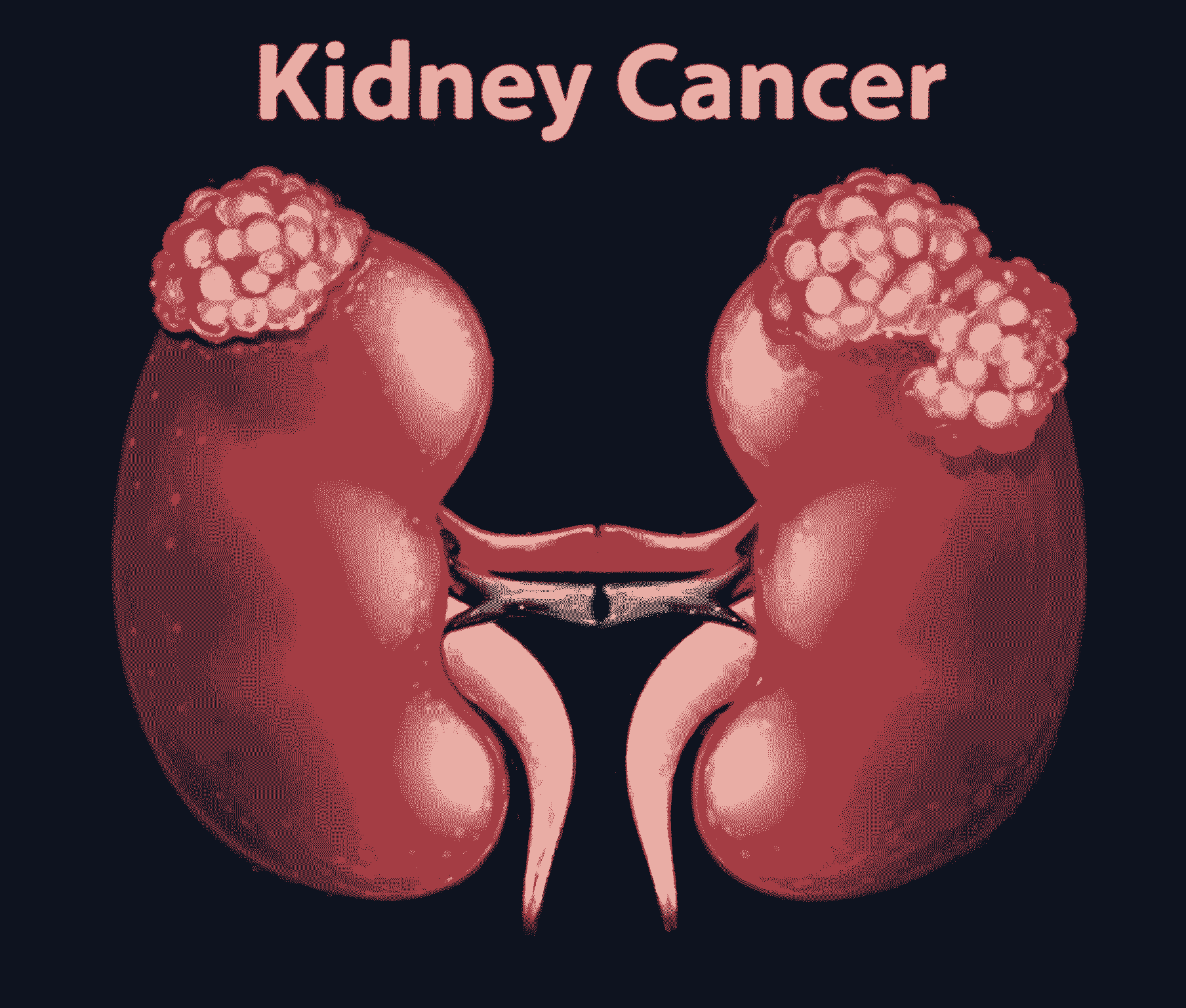 Kidney Cancer