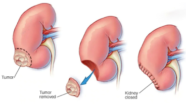 Open Partial Nephrectomy