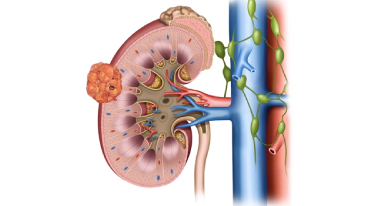 Techniques in Partial Nephrectomy