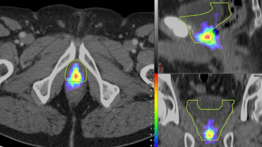 PET-CT Scan