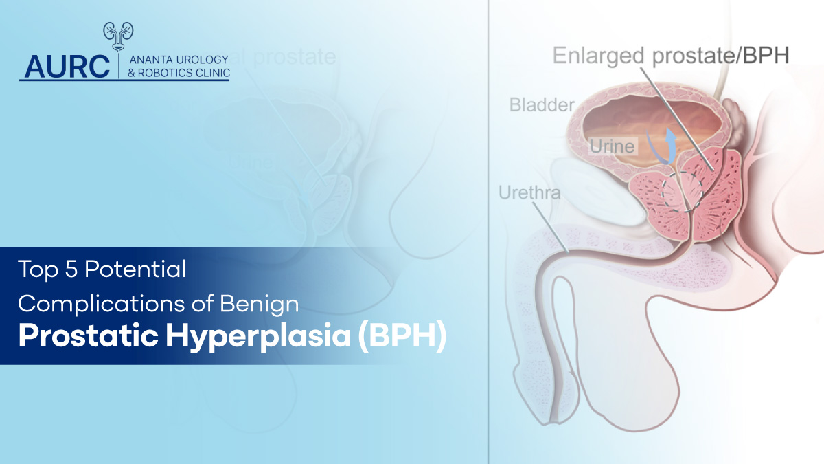 Top 5 Potential Complications of Benign Prostatic Hyperplasia (BPH)