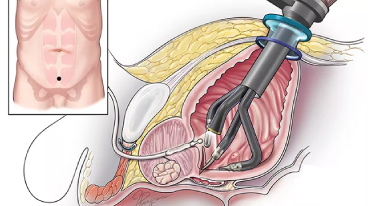 Laparoscopic Radical Prostatectomy Disadvantages