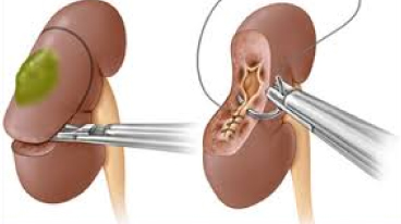 Laparoscopic Partial Nephrectomy