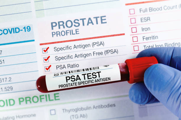 Showcasing PSA test results for understanding.